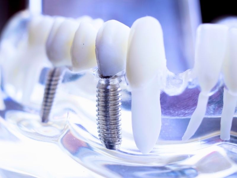 diferença entre dentadura fixa e implante e benefícios
