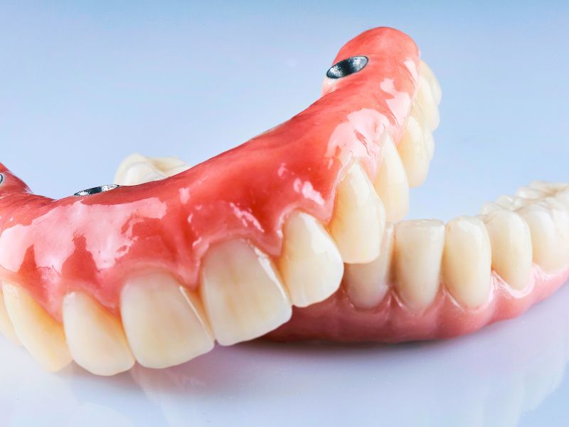 diferença entre dentadura fixa e implante e características