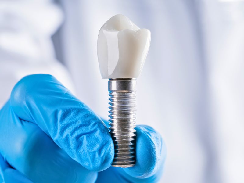 implante dentário brasília e procedimentos