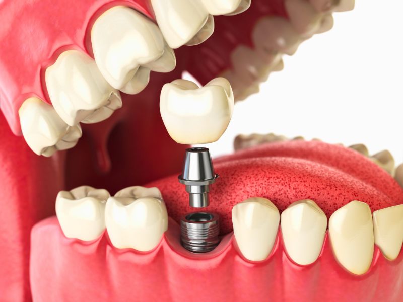 implante dentário brasília e cuidados